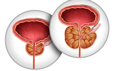 Neue minimal-invasive Verfahren zur Behandlung der gutartigen Prostatavergrößerung