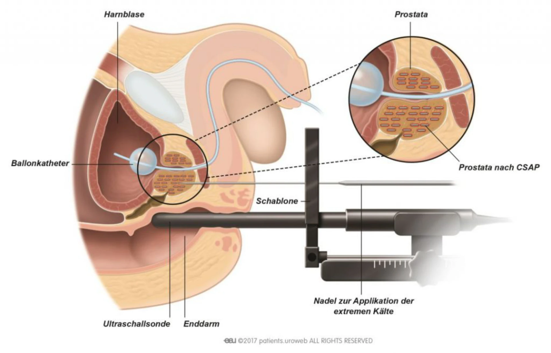 Brachytherapie bei Prostatakrebs