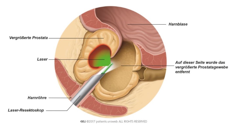 GreenLight-Lasertherapie der BPH: Moderne, schonende Behandlungsmethode