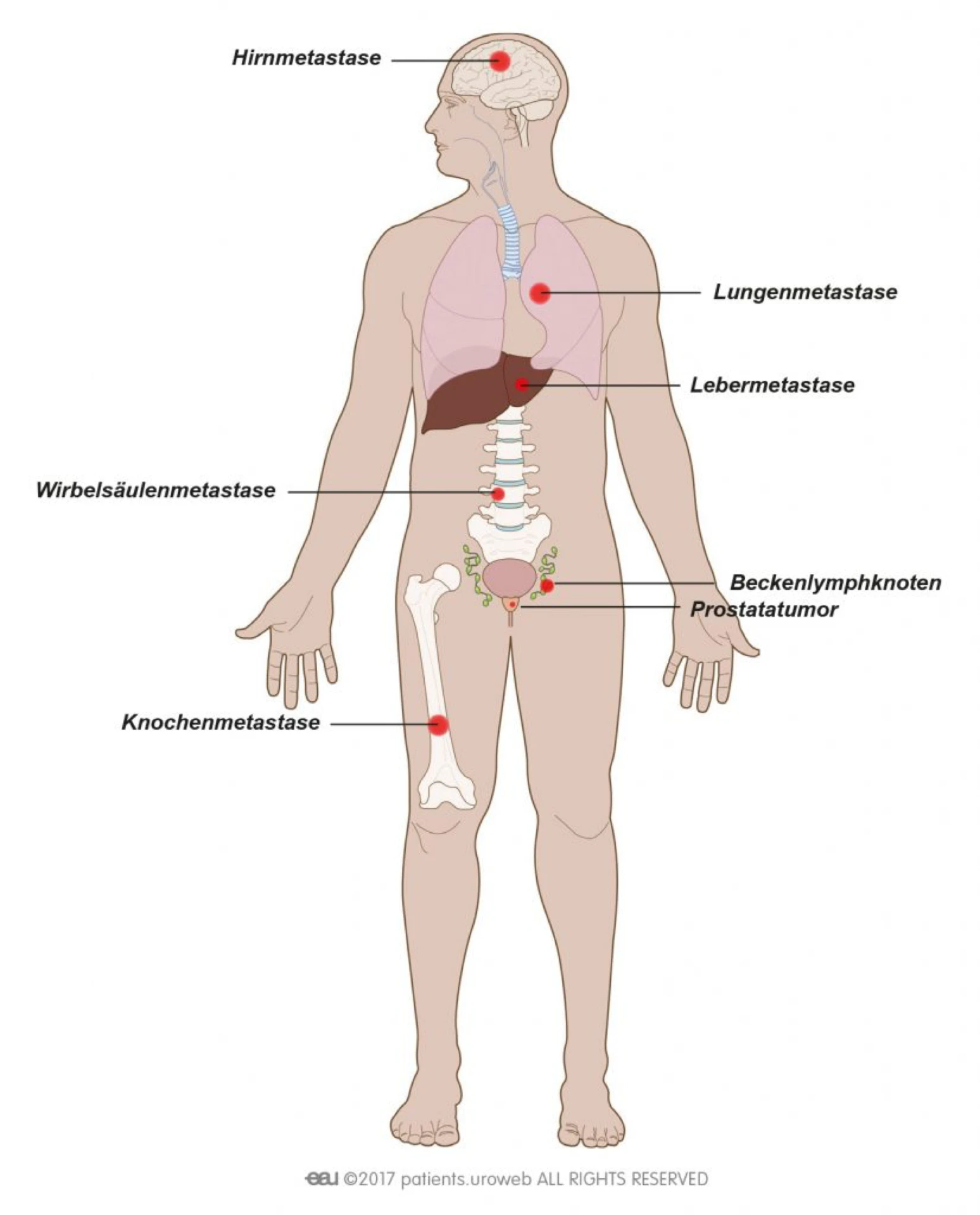 Knochenprotektion bei Prostatakarzinom