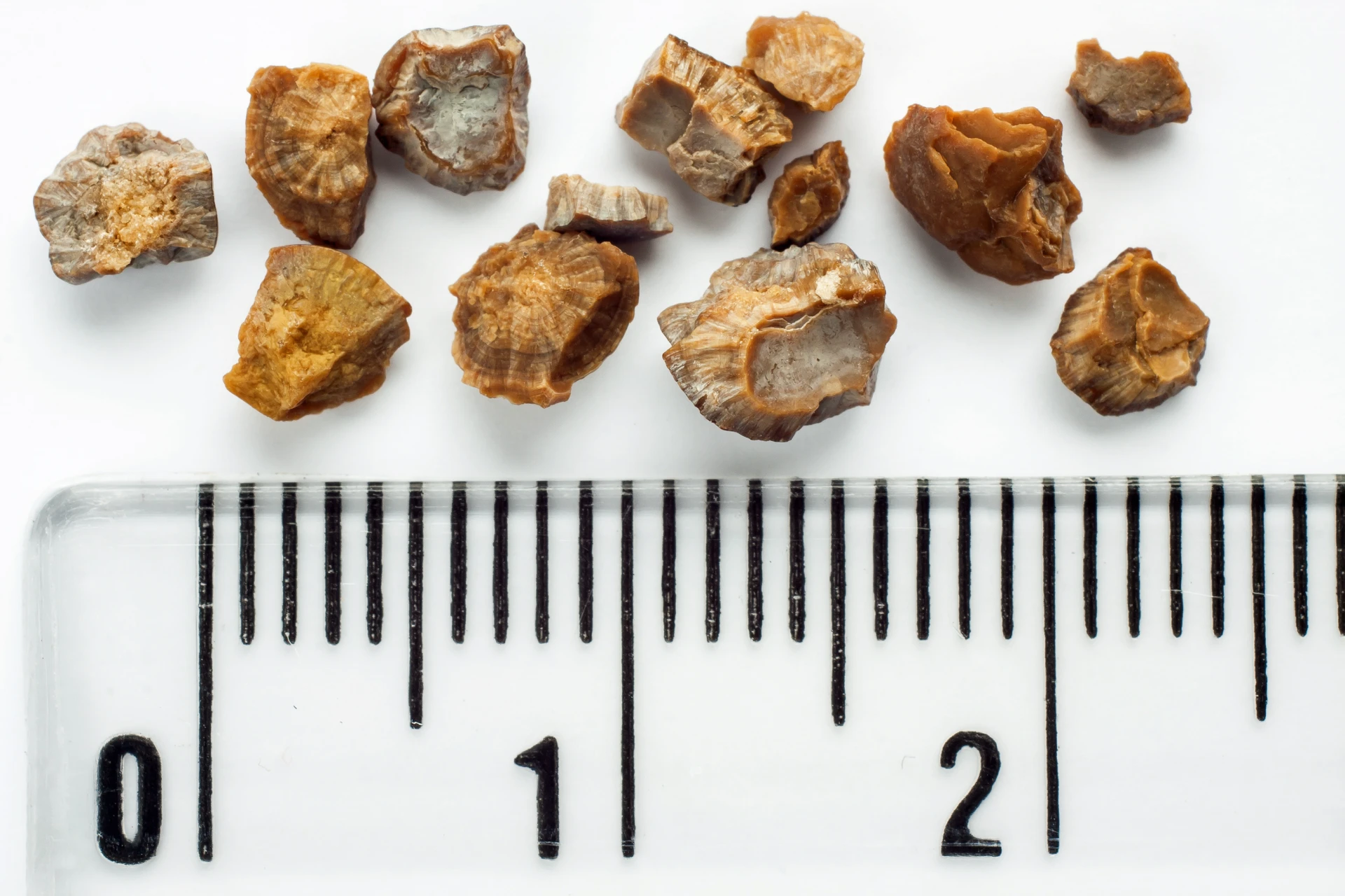 PNL bei Urolithiasis