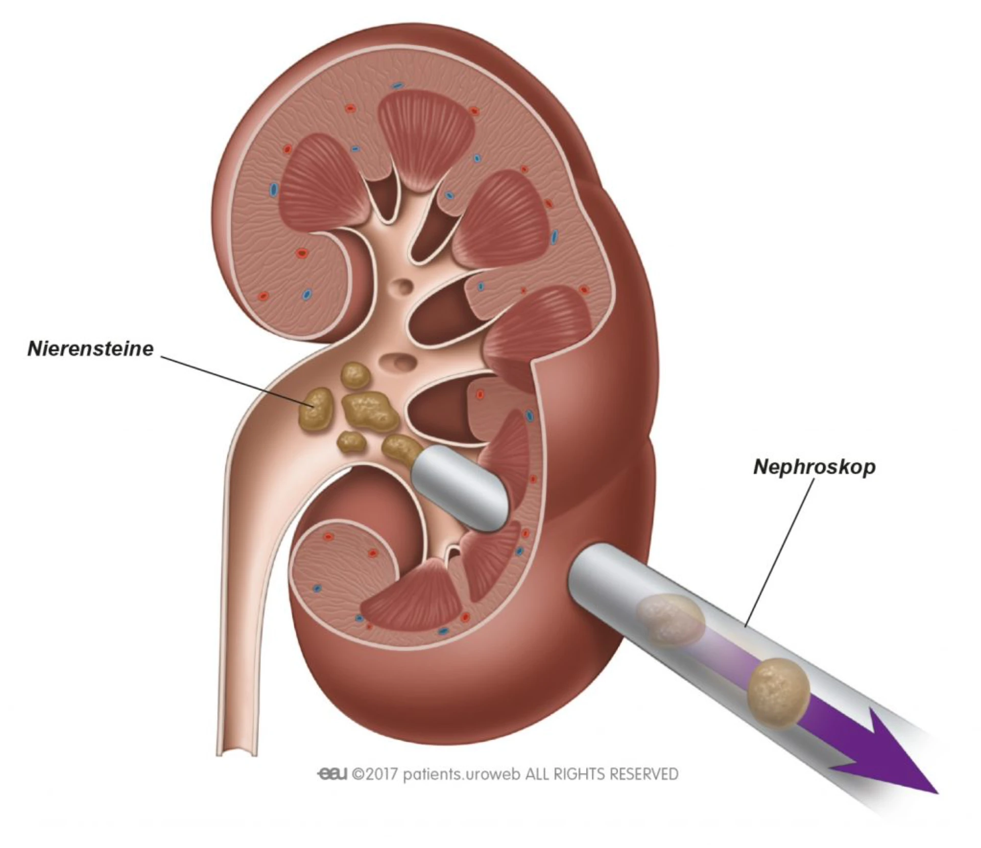 PNL bei Urolithiasis