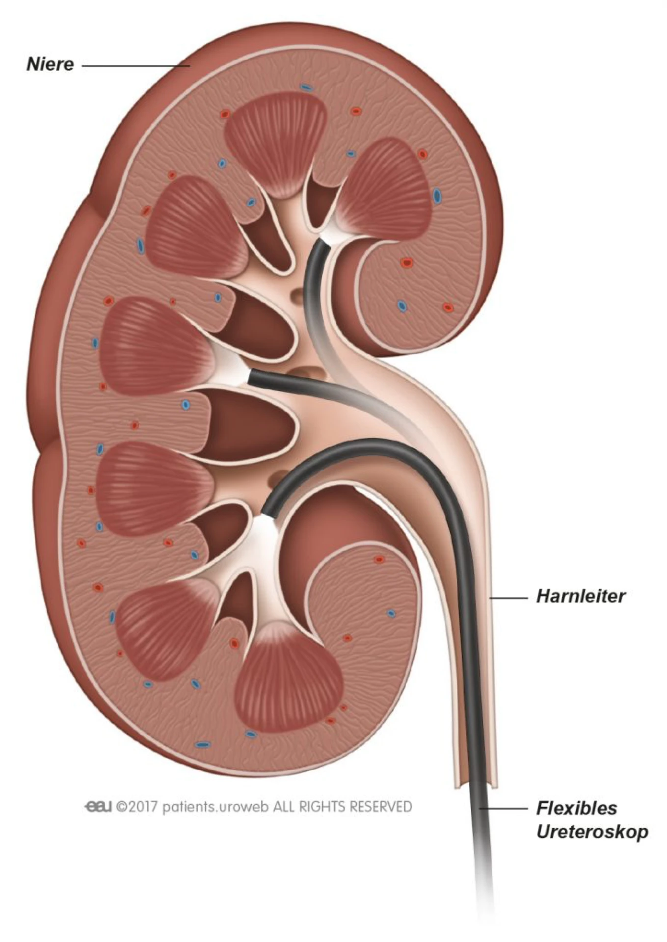 URS bei Urolithiasis