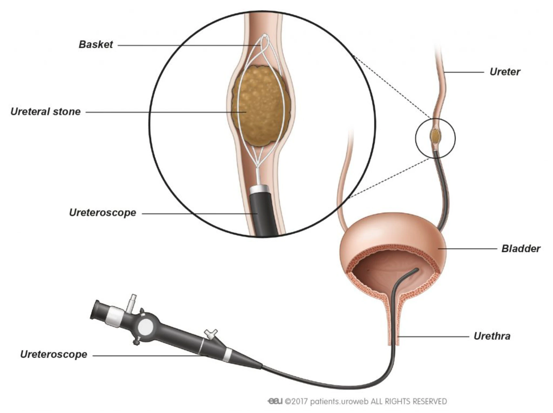 URS bei Urolithiasis