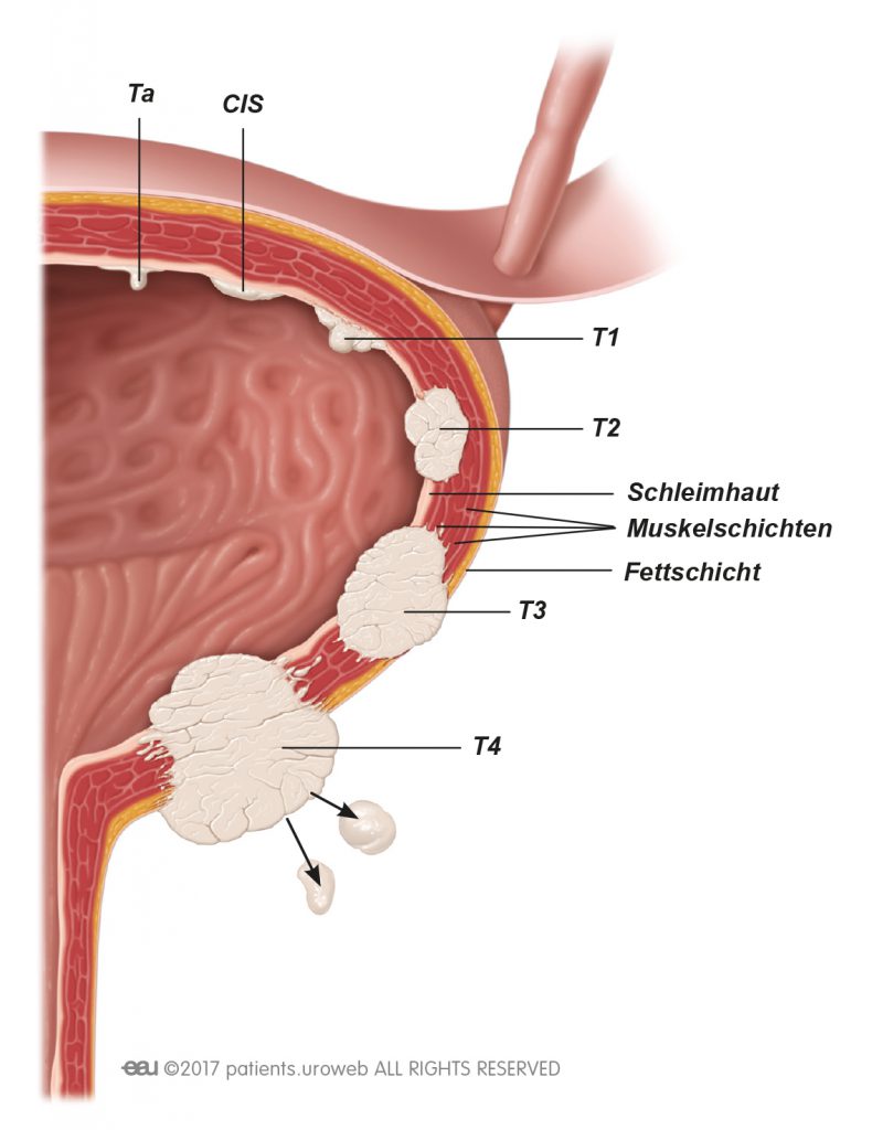 Zystektomie bei Blasenkarzinom