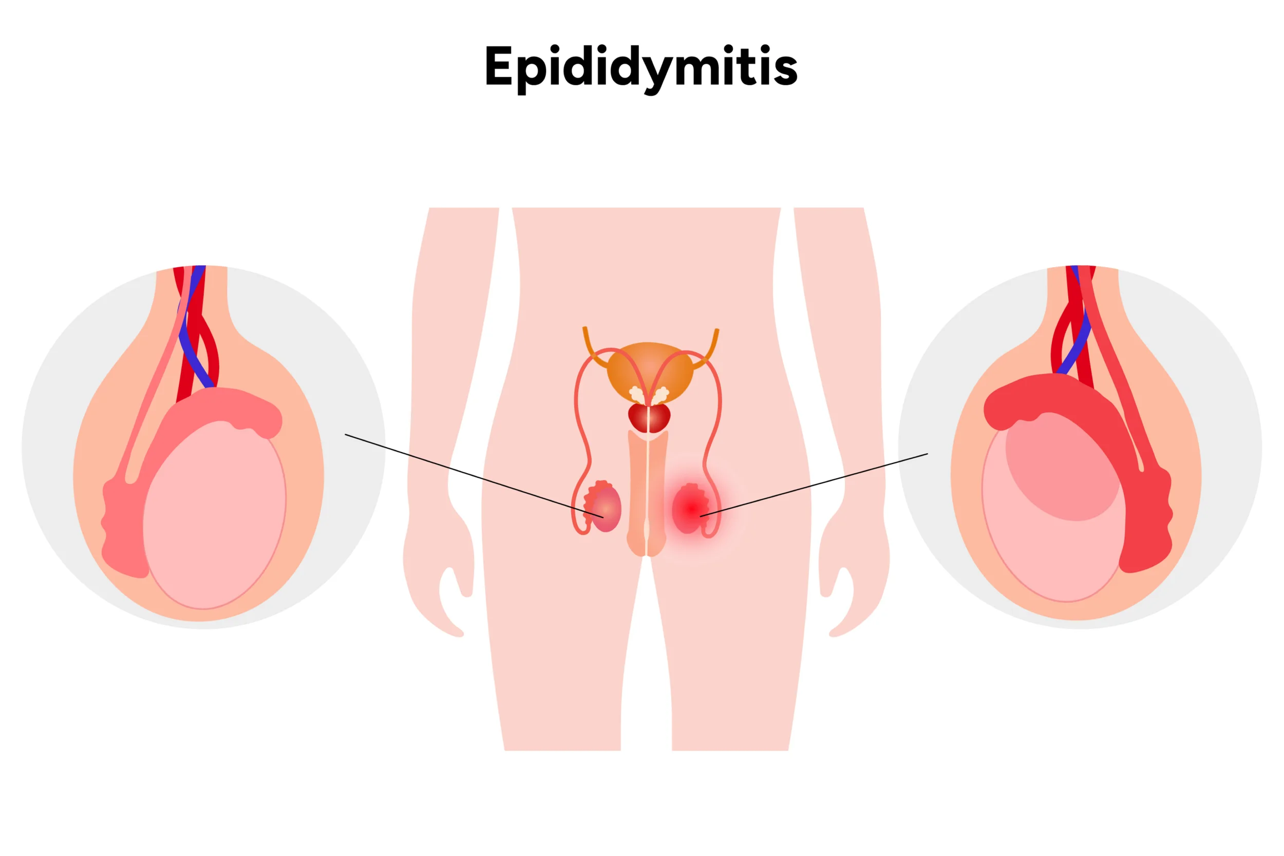 Nebenhodenentzündung (Epididymitis) Nebenhodenentzündung (Epididymitis)