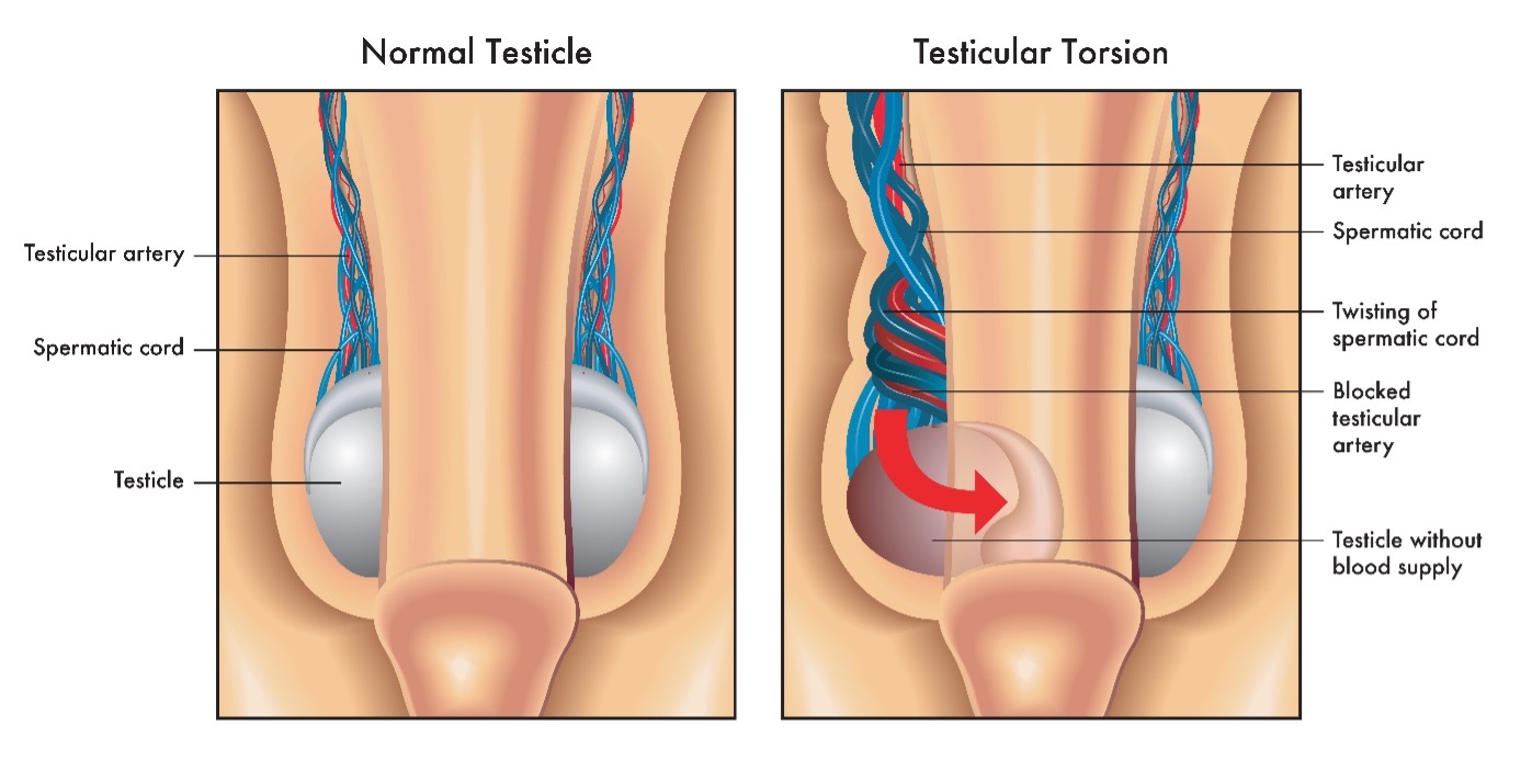 Hodentorsion (Hodendrehung) und Hydatidentorsion – Ursachen, Symptome, Diagnose und Behandlung