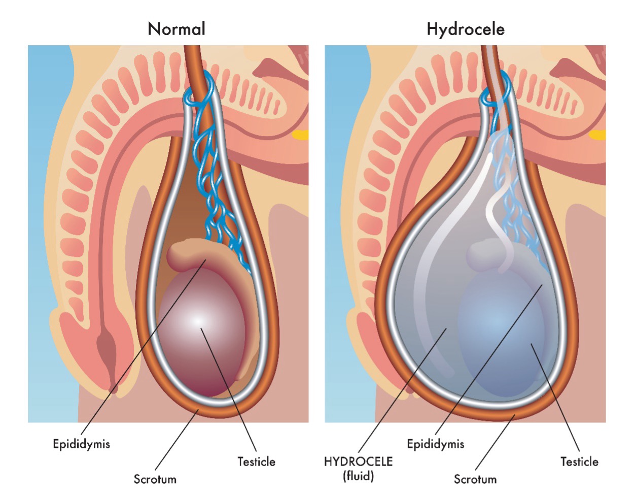 Hydrozele-01 Hodentorsion (Hodendrehung) und Hydatidentorsion – Ursachen, Symptome, Diagnose und Behandlung