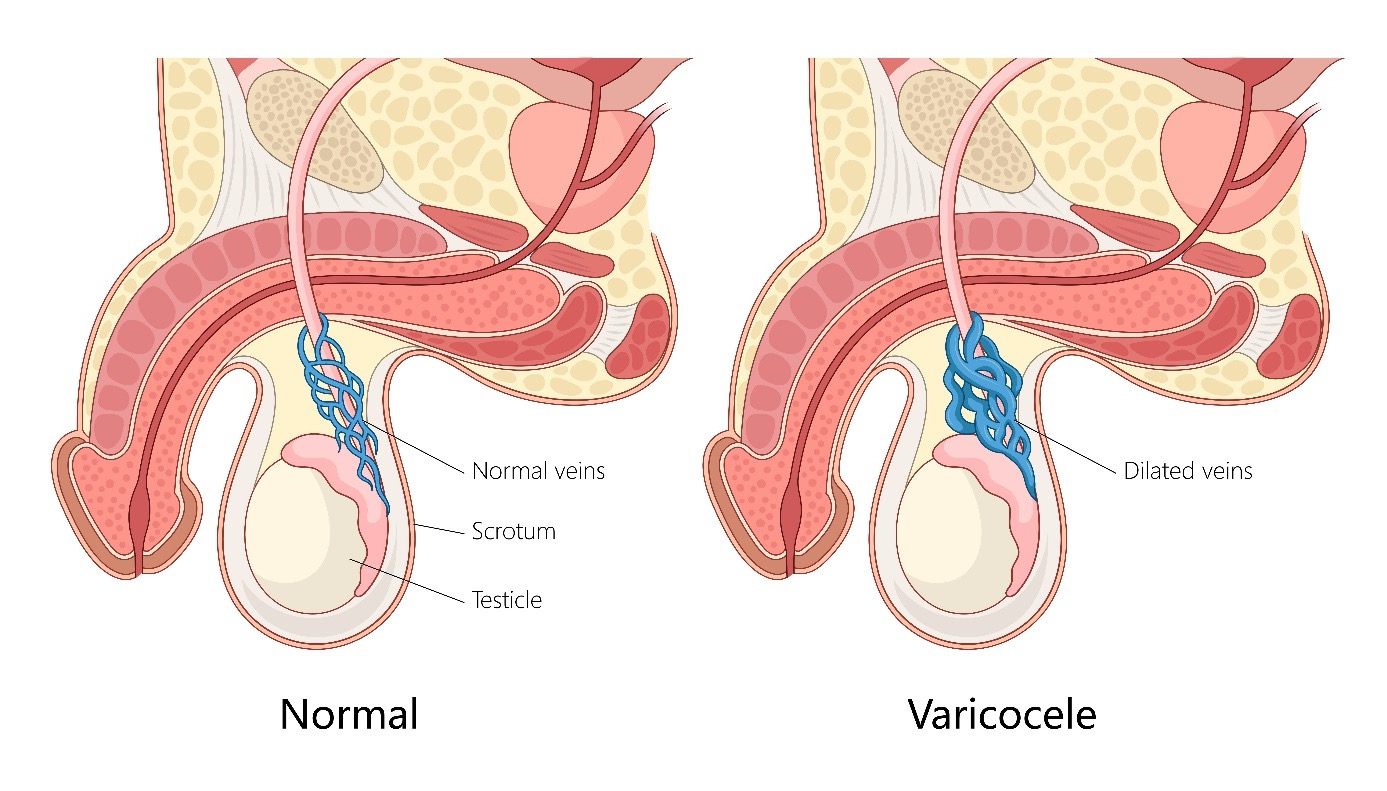 Varikozele-01 Hodentorsion (Hodendrehung) und Hydatidentorsion – Ursachen, Symptome, Diagnose und Behandlung