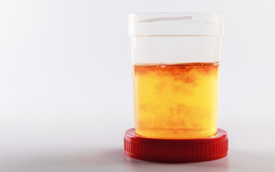 Blut im Urin: Wann harmlos, wann Alarmzeichen?