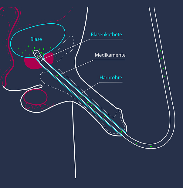 Blasenkatheter-01-Ausschnitt-neu